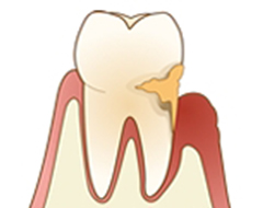 歯周病治療
